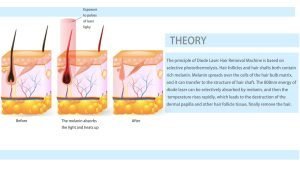 808 nm diode laser hair removal theory