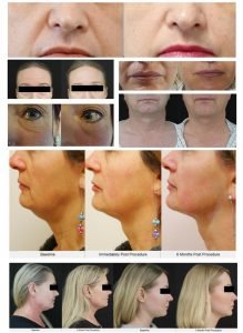 7D hifu machine before and after