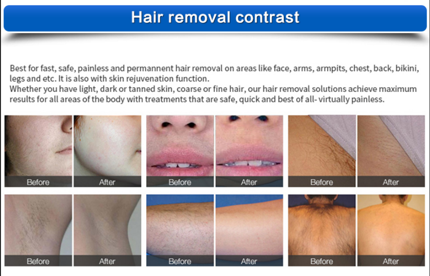 laser hair removal before and after