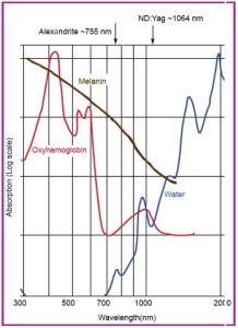 alex laser hair removal